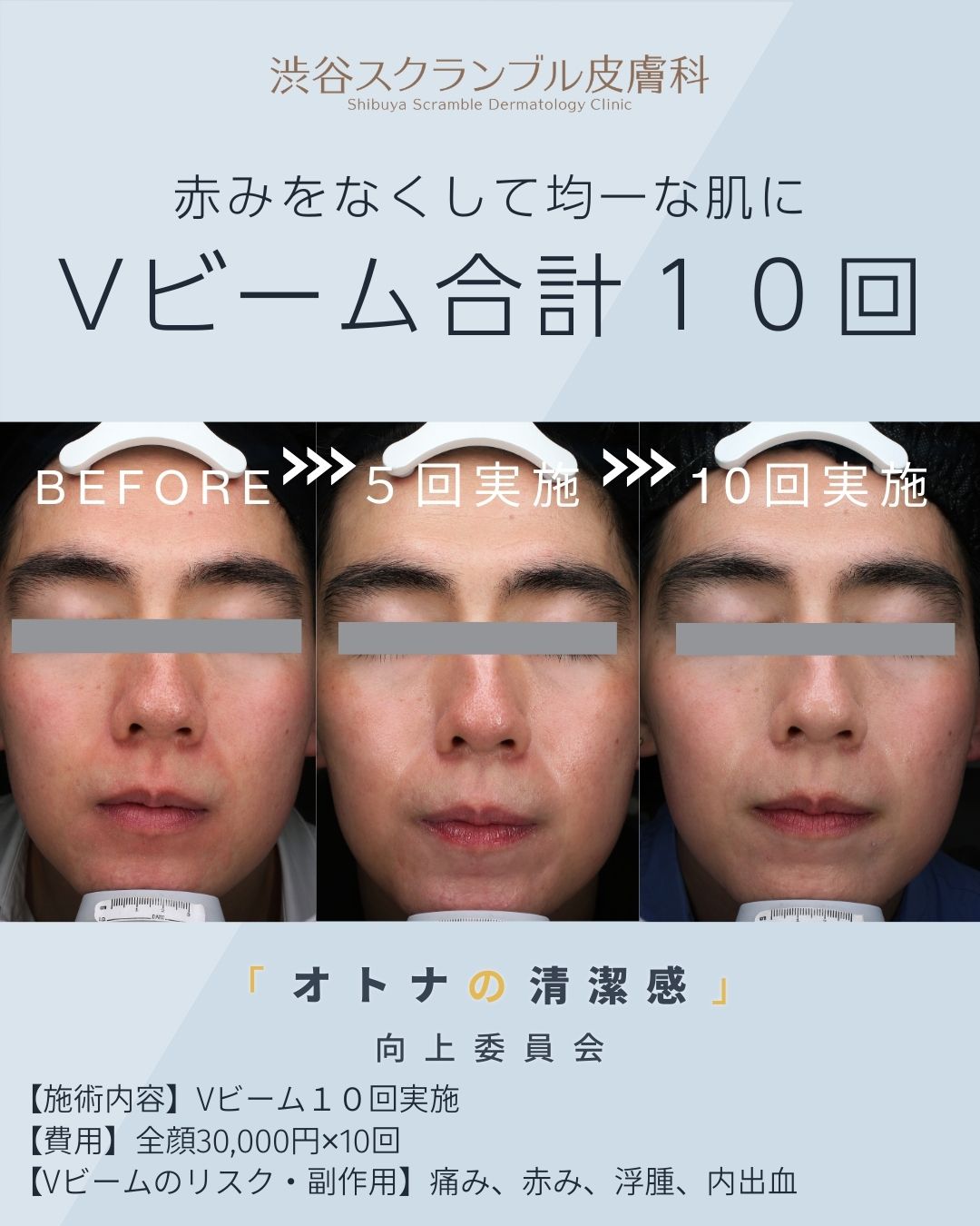 Vビーム(全顔)合計10回の治療前・5回後・10回後の症例写真(当院インスタグラム)