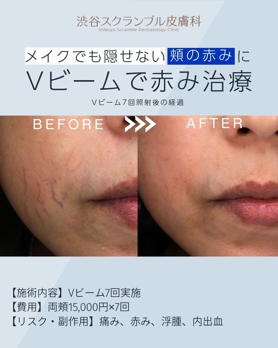 頬の赤みにVビーム(両頬)を7回照射した治療前後の症例写真(当院インスタグラム)