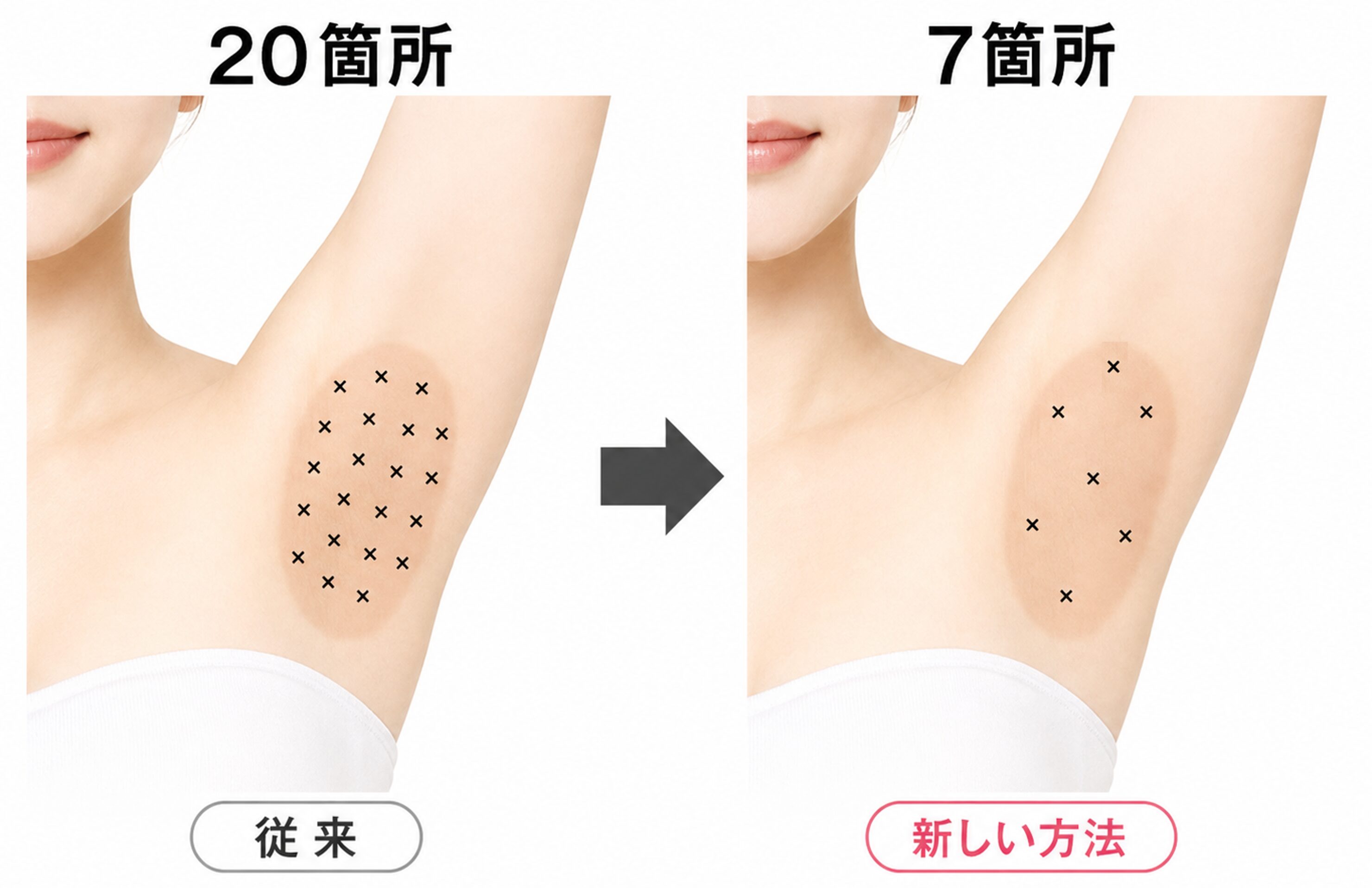 ワキへの注射位置の比較。従来の20箇所と、当院が採用する7箇所