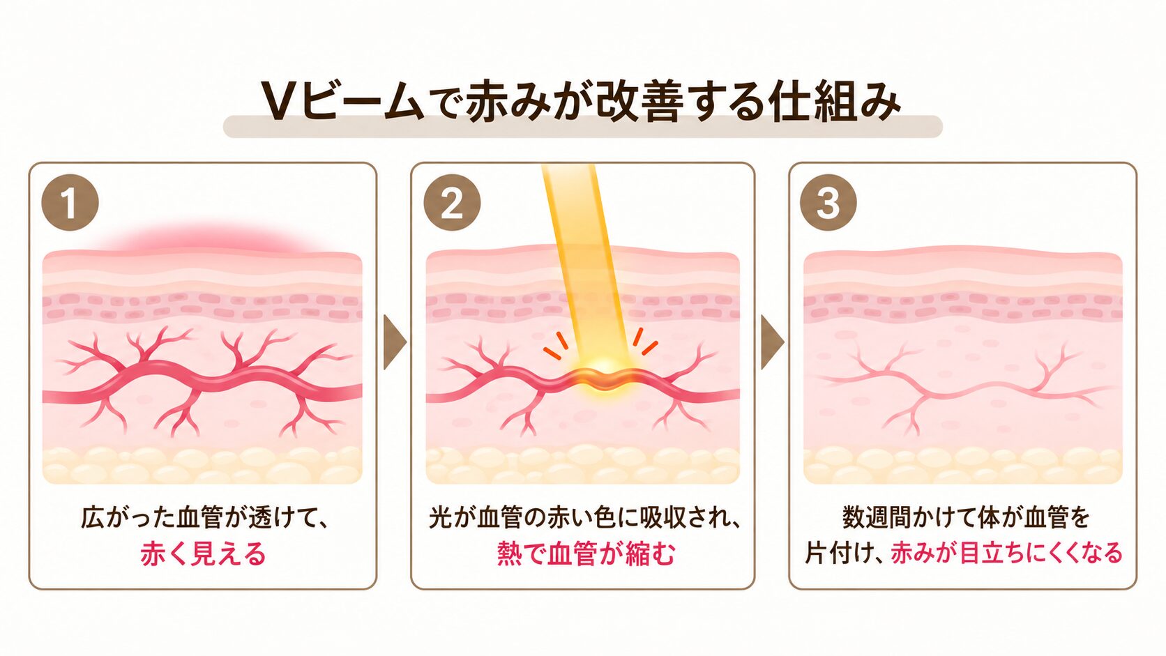 Vビームで赤みが目立ちにくくなる仕組み:①広がった血管が透けて赤く見える ②光が血管の赤い色に吸収され、熱で血管が縮む ③数週間かけて体が血管を片付け、赤みが目立ちにくくなる